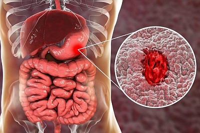 Affected stomach